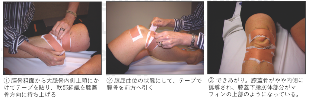 膝蓋下脂肪体インピンジメントに対するテーピングについて Curious Physiotherapy